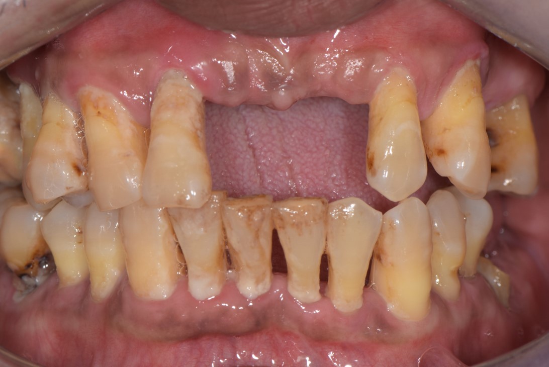 重度牙周炎範例 